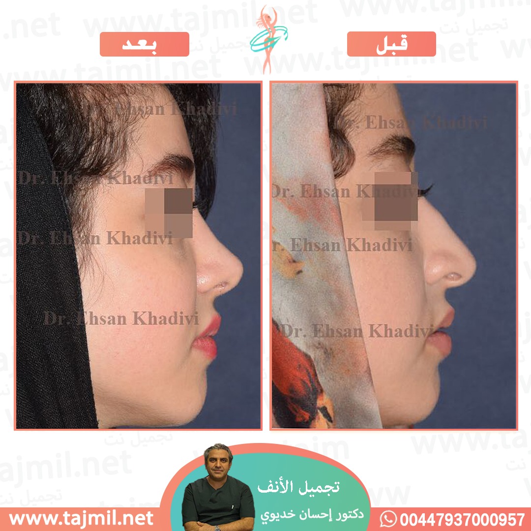  - دکتور إحسان خدیوي عملية تجميل الانف في ايران مع تجميل نت