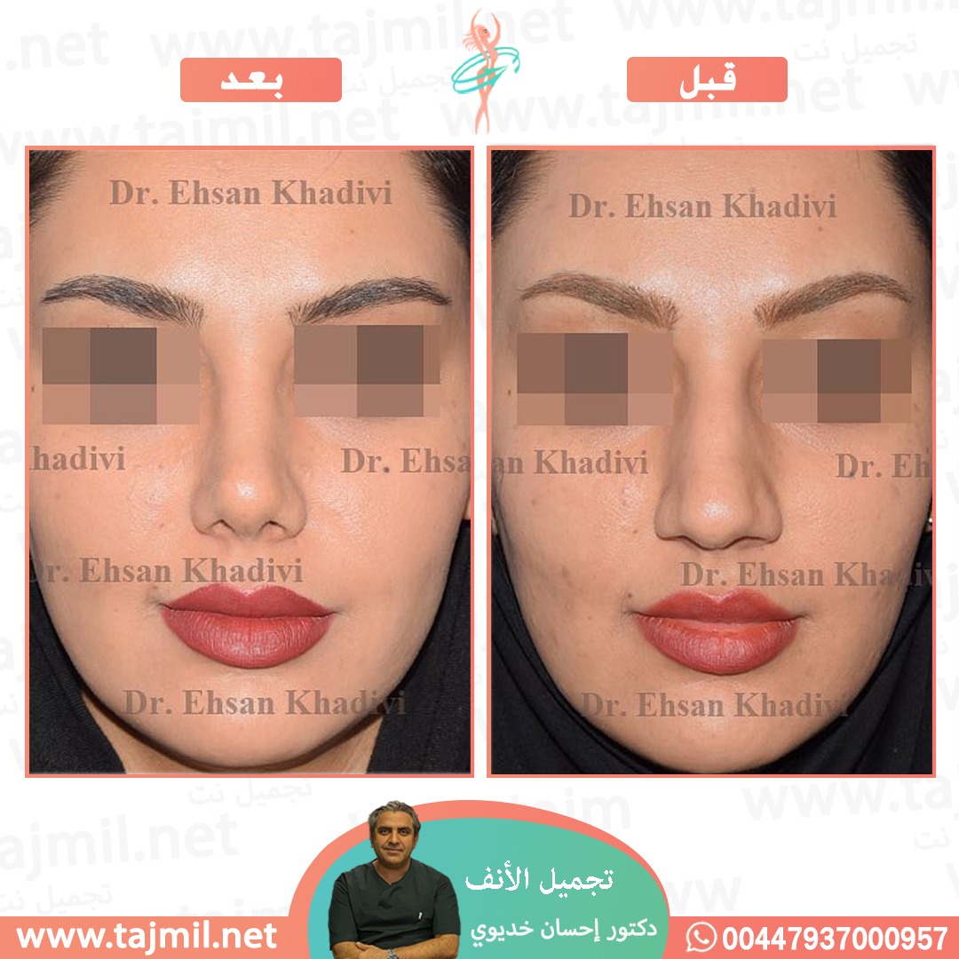  - دکتور إحسان خدیوي عملية تجميل الانف في ايران مع تجميل نت