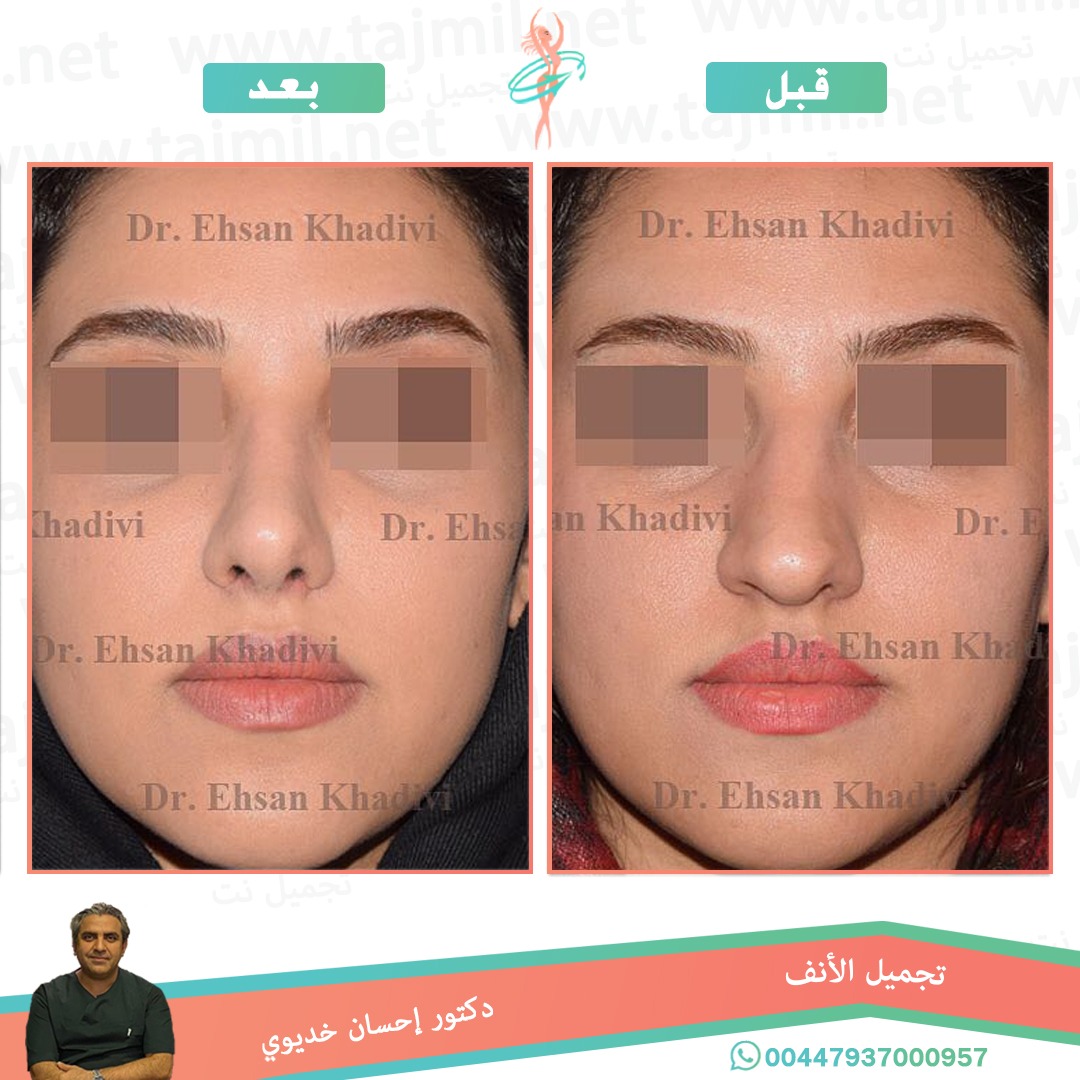  - دکتور إحسان خدیوي عملية تجميل الانف في ايران مع تجميل نت