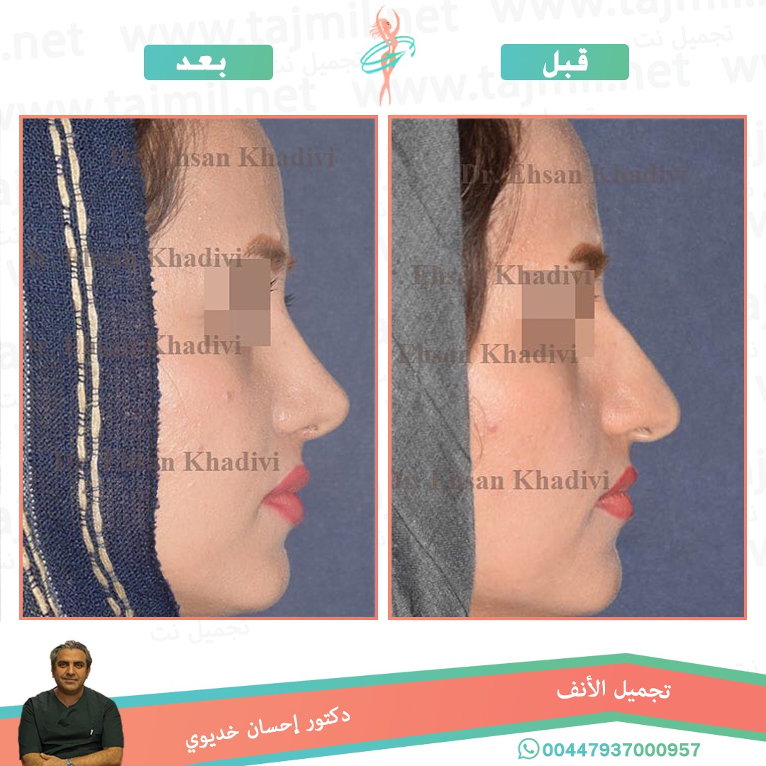  - دکتور إحسان خدیوي عملية تجميل الانف في ايران مع تجميل نت