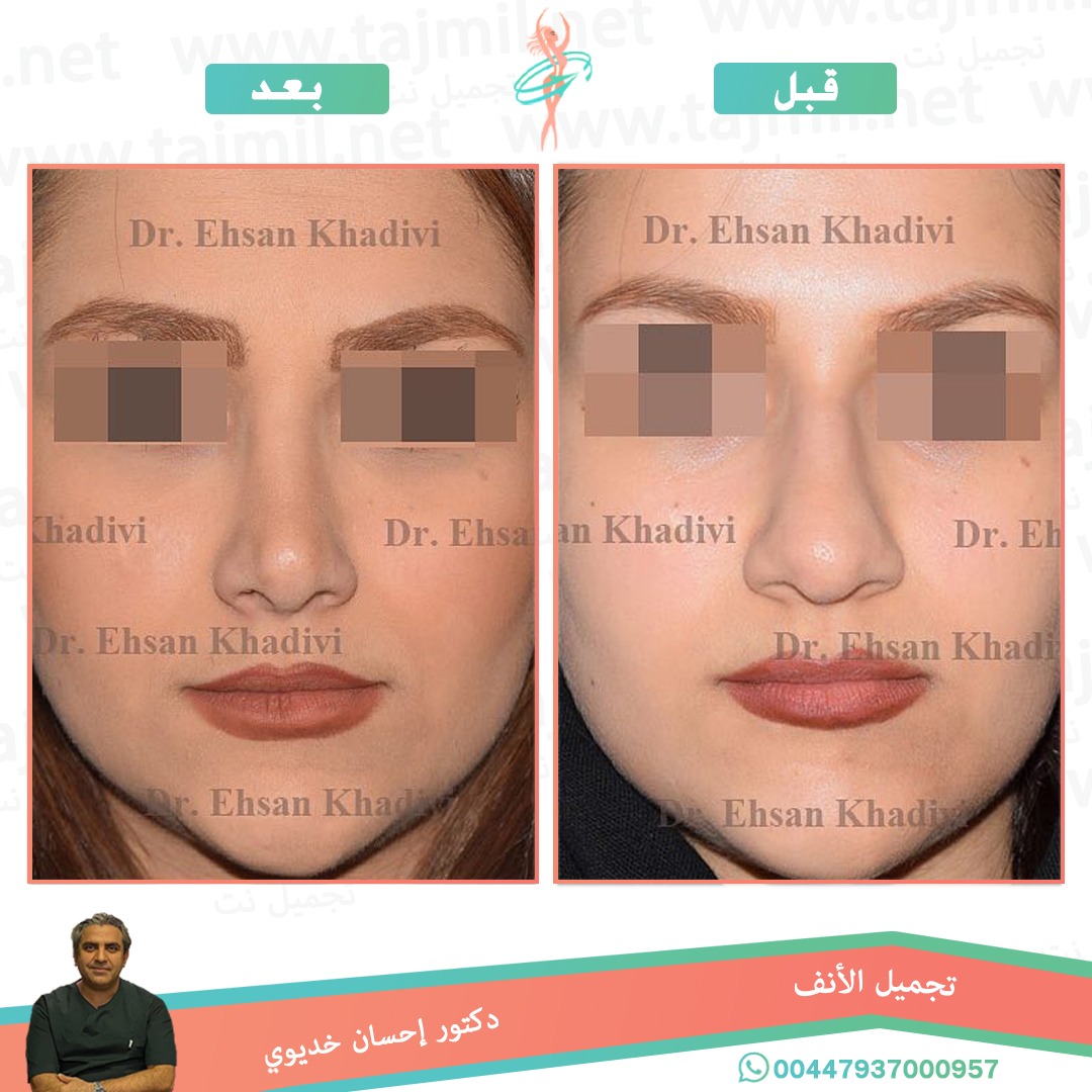  - دکتور إحسان خدیوي عملية تجميل الانف في ايران مع تجميل نت