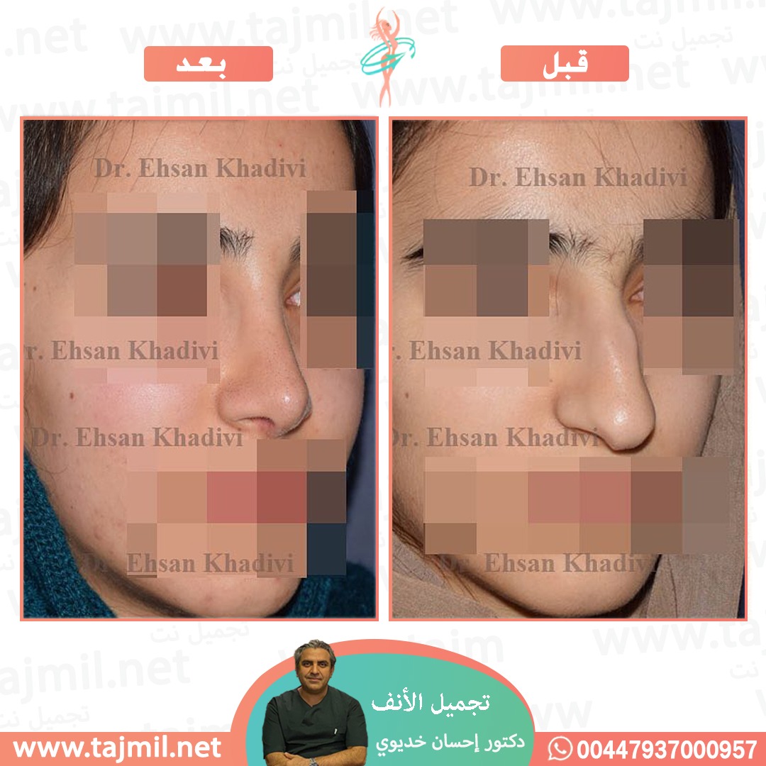  - دکتور إحسان خدیوي عملية تجميل الانف في ايران مع تجميل نت