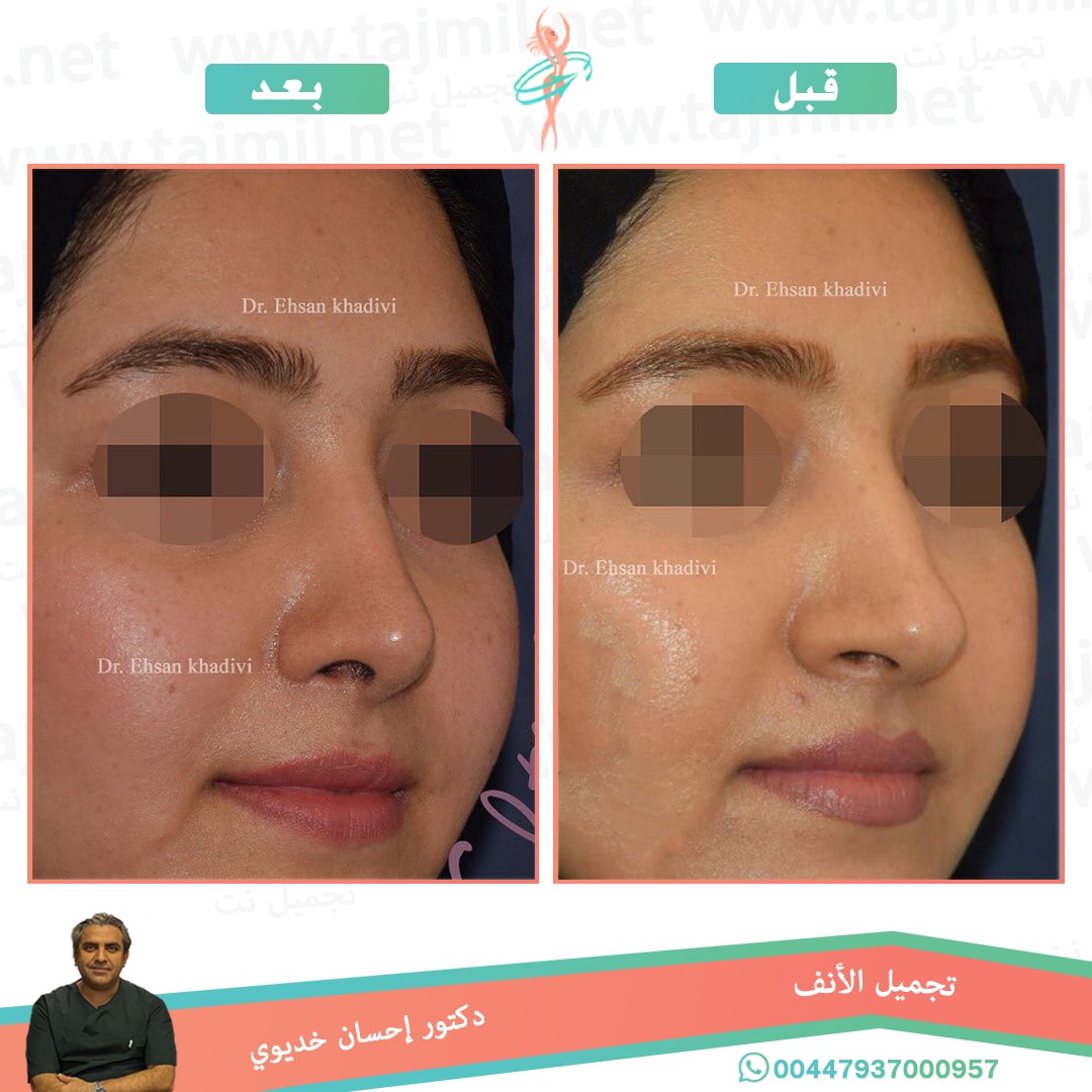  - دکتور إحسان خدیوي عملية تجميل الانف في ايران مع تجميل نت