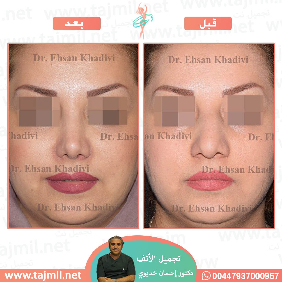  - دکتور إحسان خدیوي عملية تجميل الانف في ايران مع تجميل نت