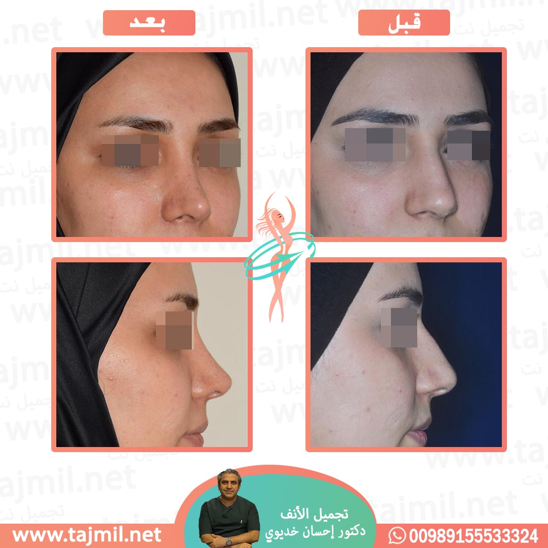  - دکتور إحسان خدیوي عملية تجميل الانف في ايران مع تجميل نت