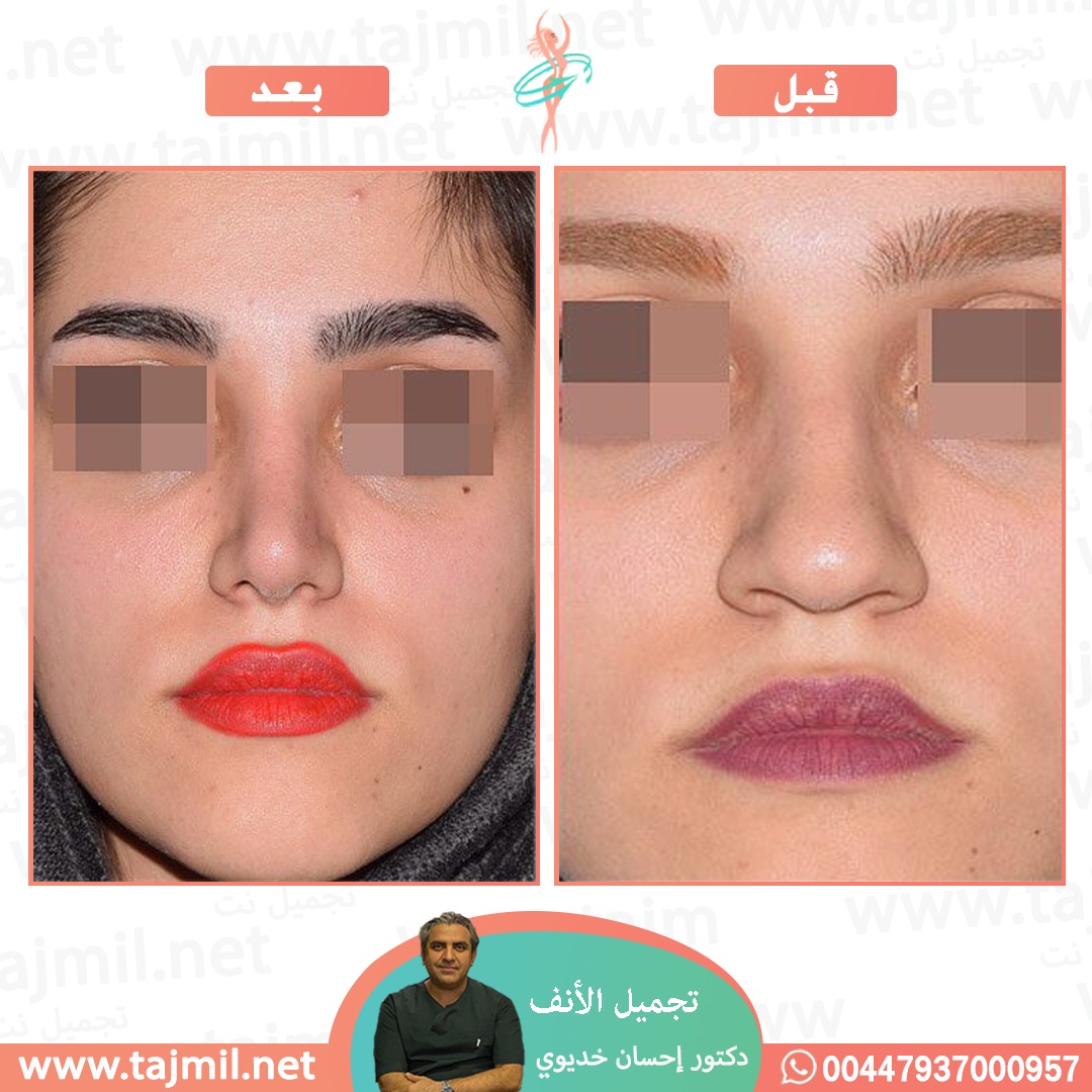  - دکتور إحسان خدیوي عملية تجميل الانف في ايران مع تجميل نت