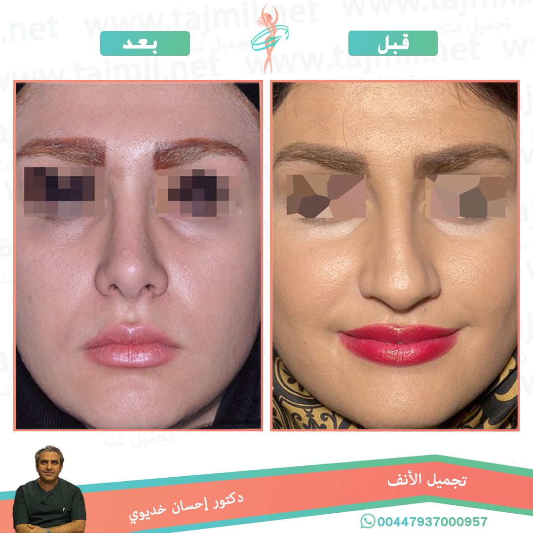  - دکتور إحسان خدیوي عملية تجميل الانف في ايران مع تجميل نت