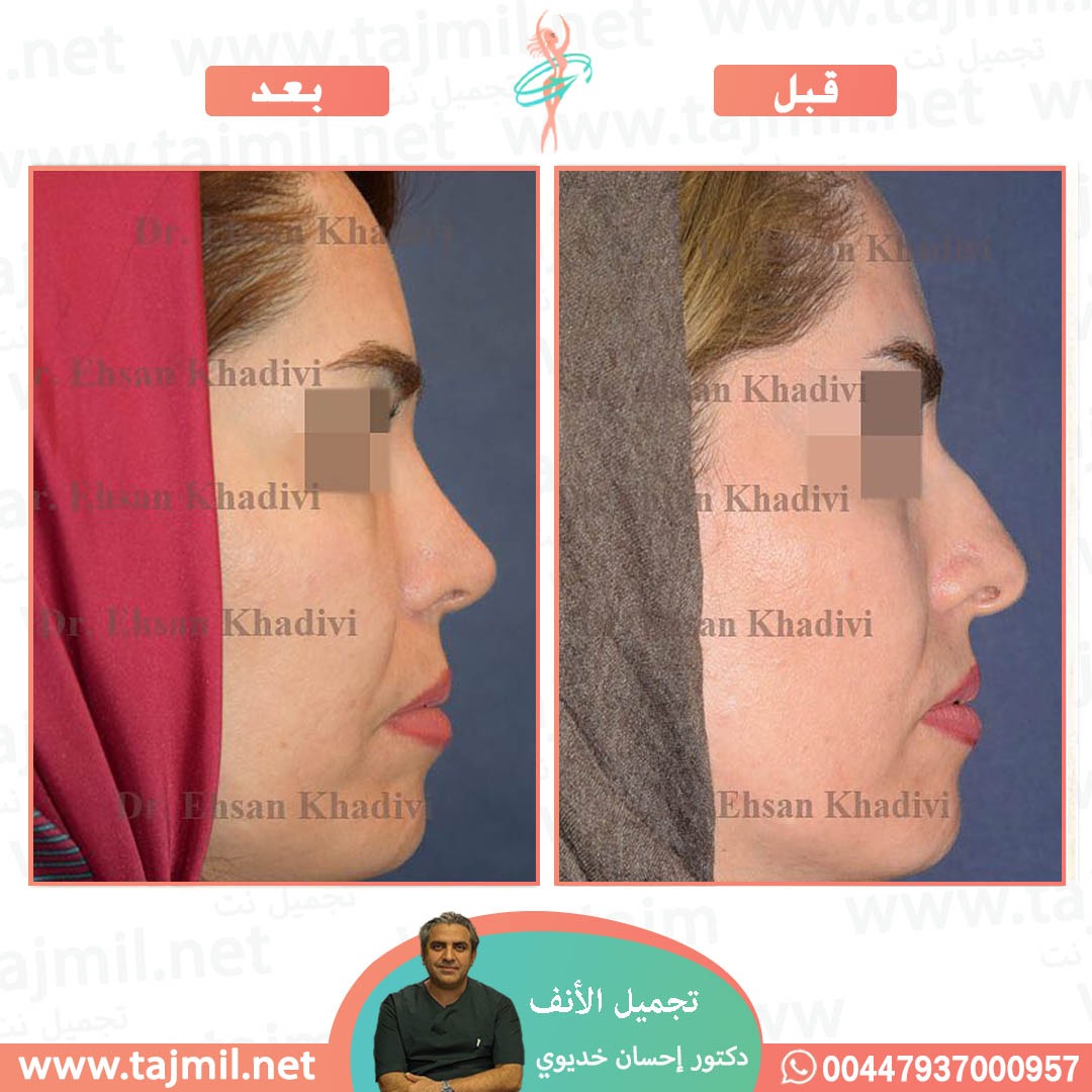  - دکتور إحسان خدیوي عملية تجميل الانف في ايران مع تجميل نت