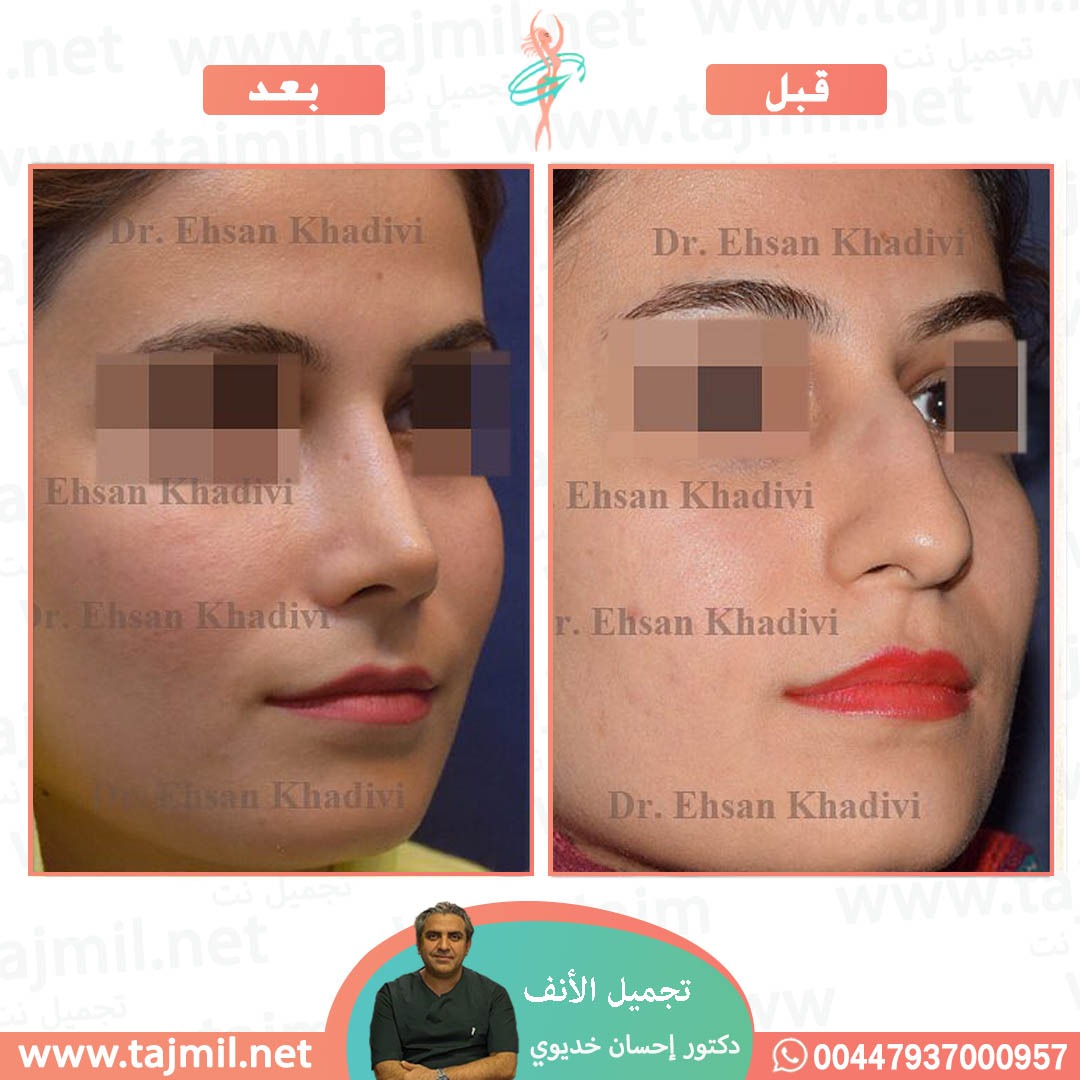  - دکتور إحسان خدیوي عملية تجميل الانف في ايران مع تجميل نت