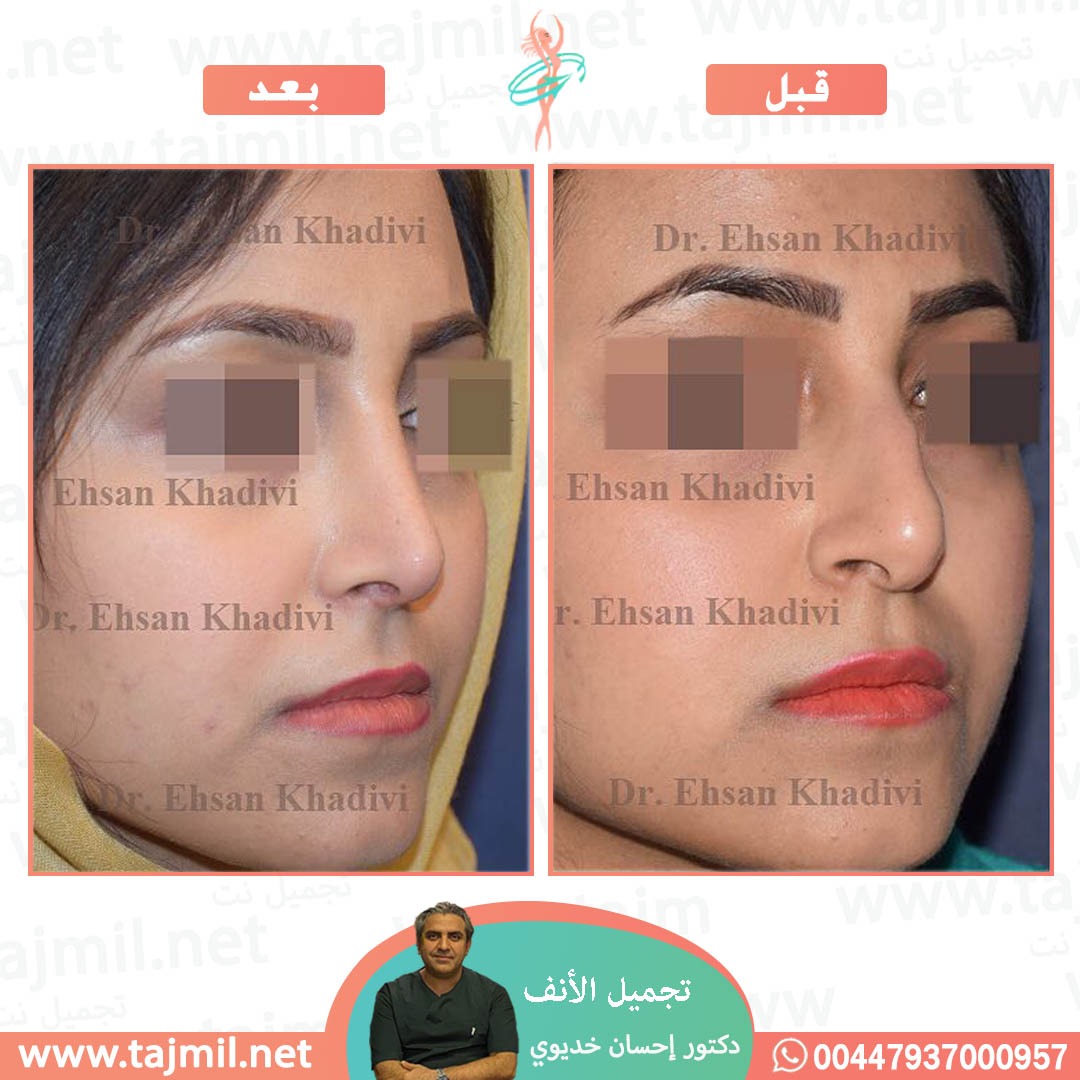  - دکتور إحسان خدیوي عملية تجميل الانف في ايران مع تجميل نت