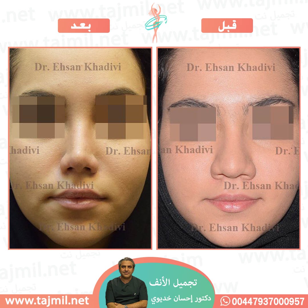  - دکتور إحسان خدیوي عملية تجميل الانف في ايران مع تجميل نت