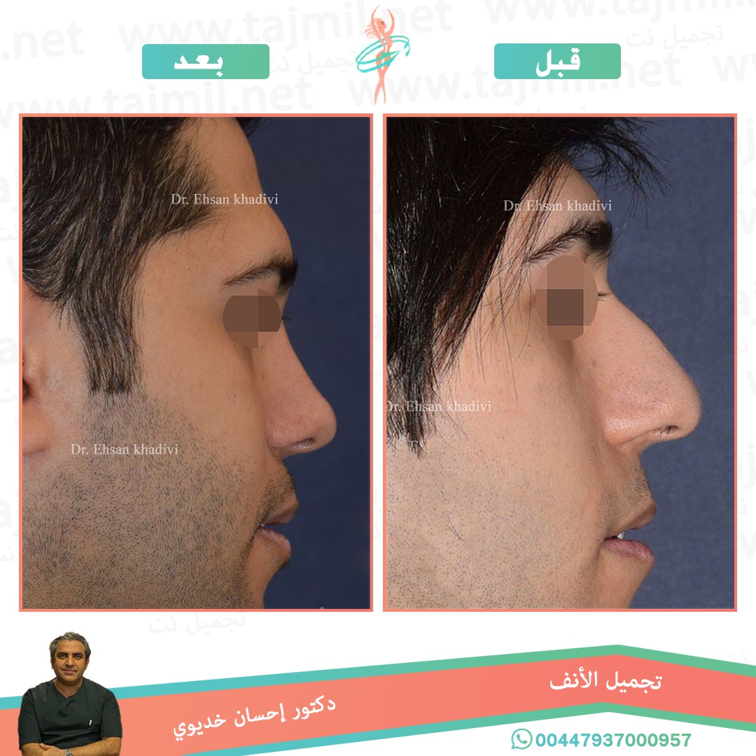  - دکتور إحسان خدیوي عملية تجميل الانف في ايران مع تجميل نت