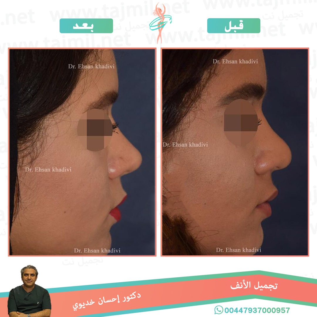  - دکتور إحسان خدیوي عملية تجميل الانف في ايران مع تجميل نت