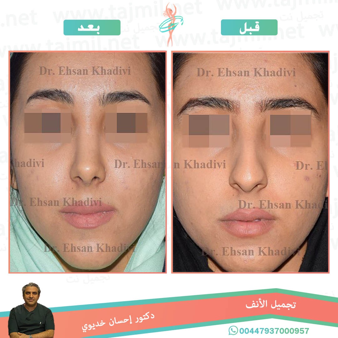  - دکتور إحسان خدیوي عملية تجميل الانف في ايران مع تجميل نت