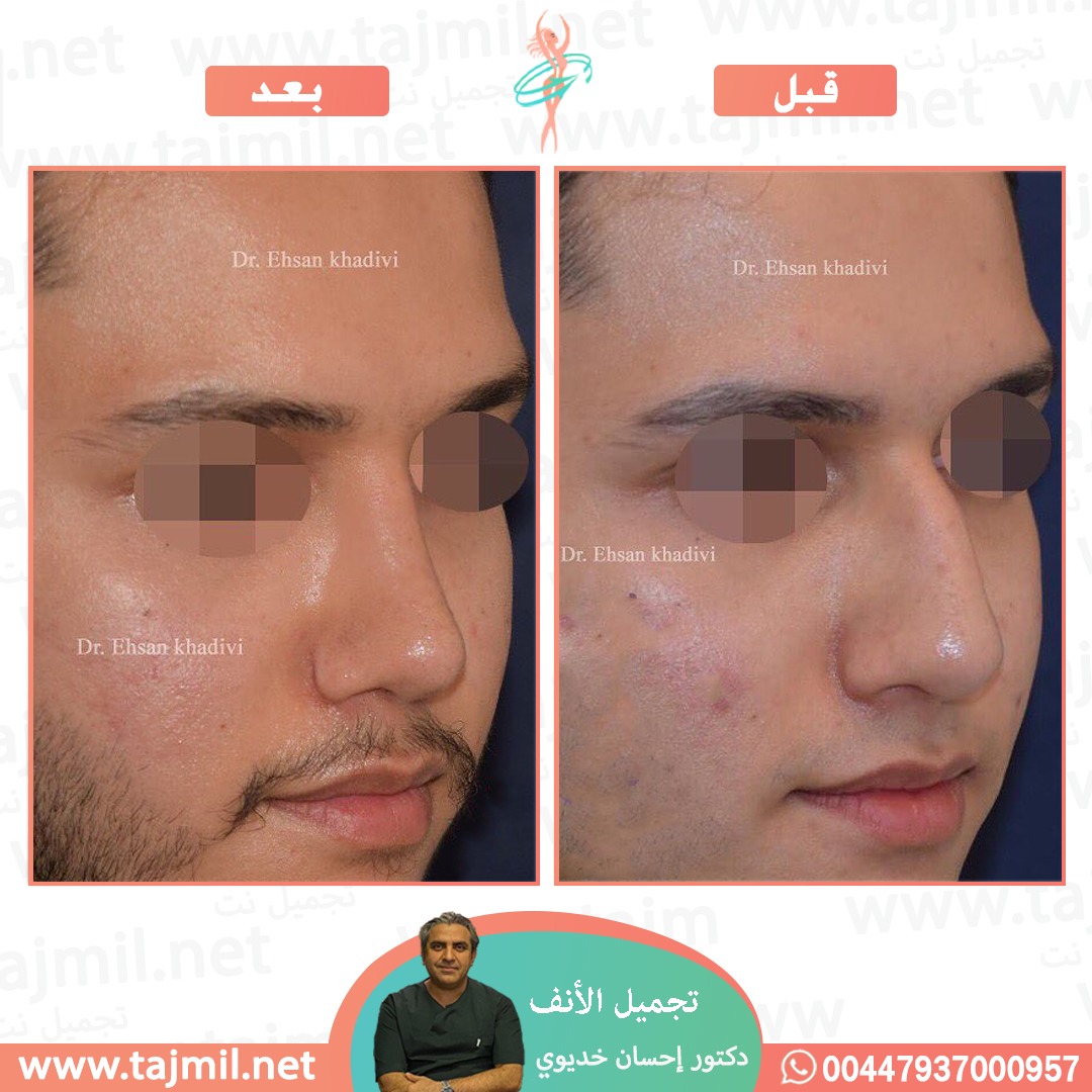  - دکتور إحسان خدیوي عملية تجميل الانف في ايران مع تجميل نت