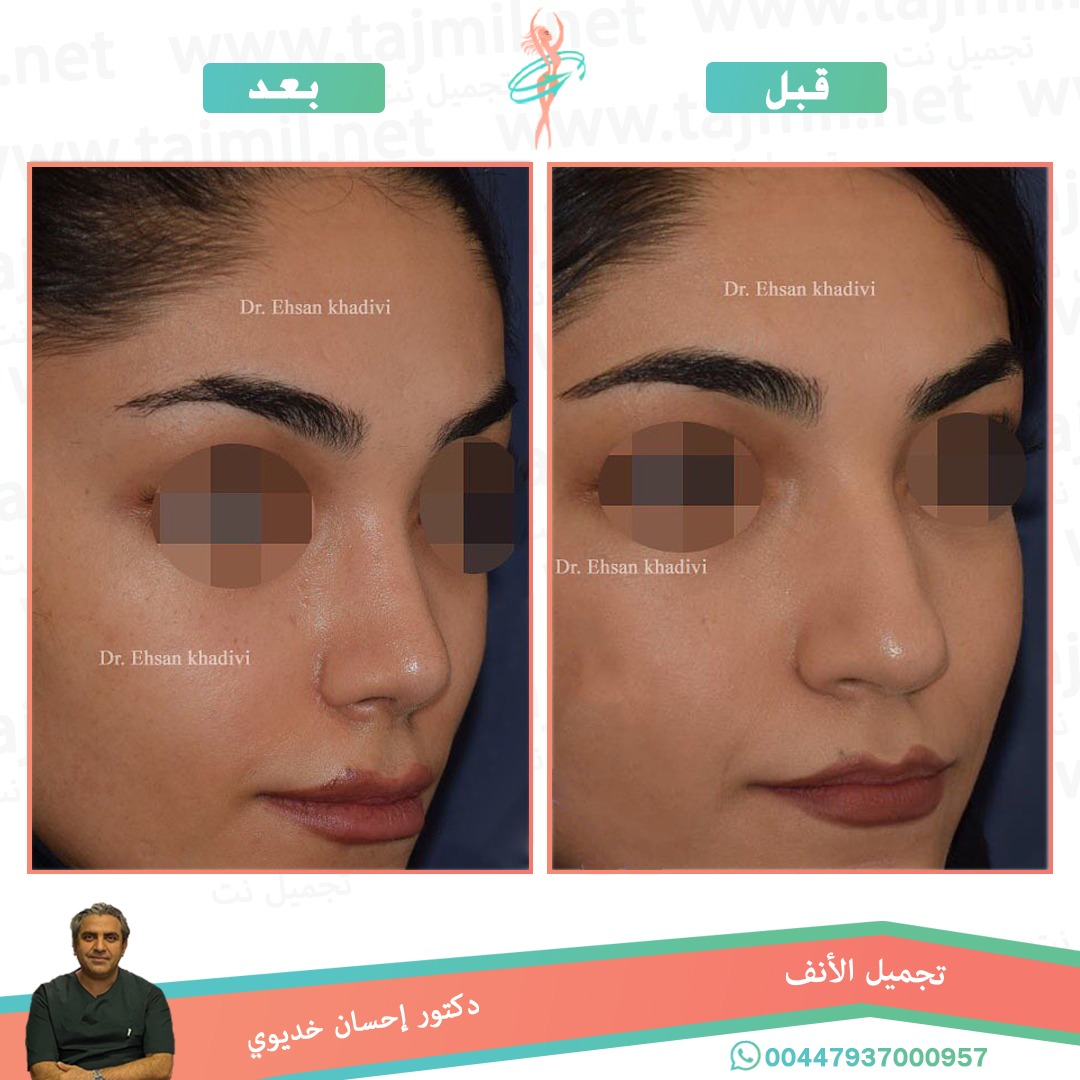  - دکتور إحسان خدیوي عملية تجميل الانف في ايران مع تجميل نت