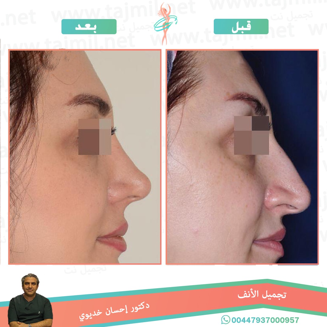  - دکتور إحسان خدیوي عملية تجميل الانف في ايران مع تجميل نت