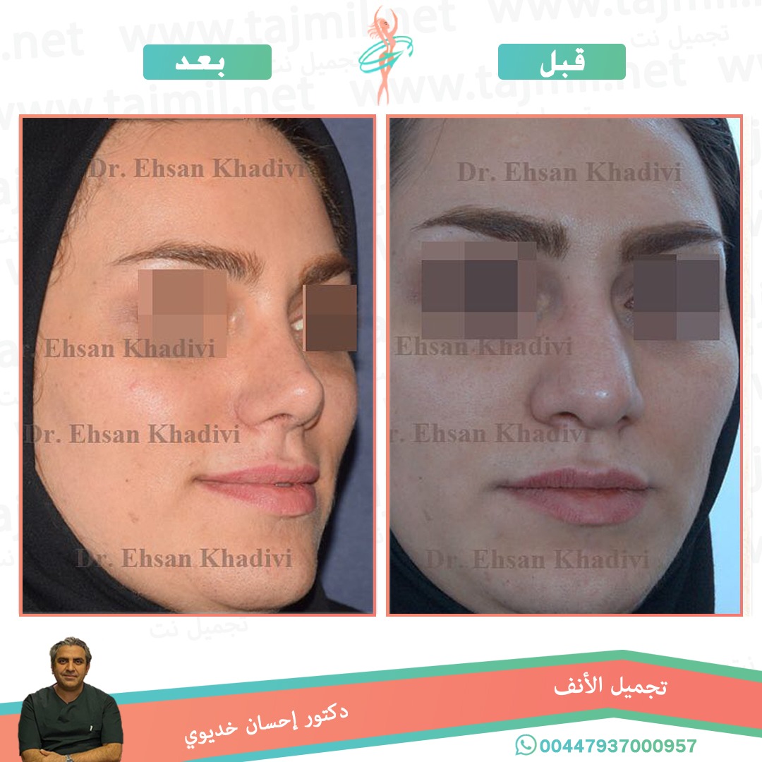  - دکتور إحسان خدیوي عملية تجميل الانف في ايران مع تجميل نت