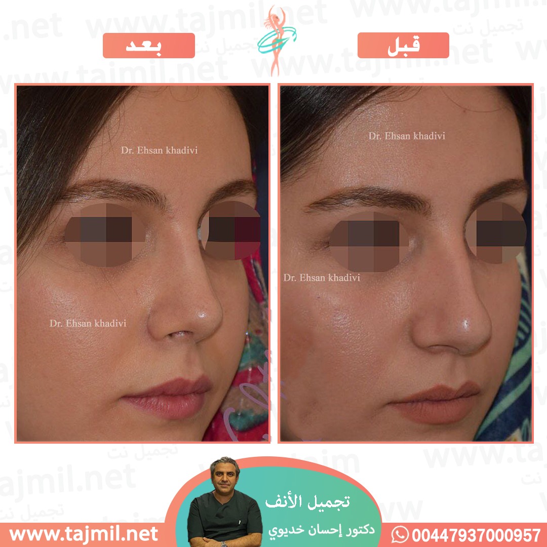  - دکتور إحسان خدیوي عملية تجميل الانف في ايران مع تجميل نت