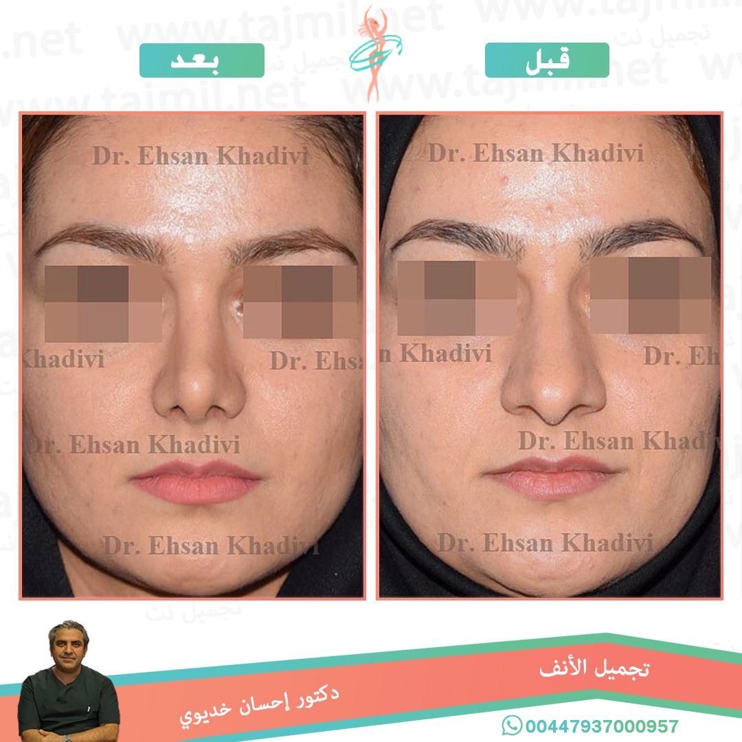  - دکتور إحسان خدیوي عملية تجميل الانف في ايران مع تجميل نت