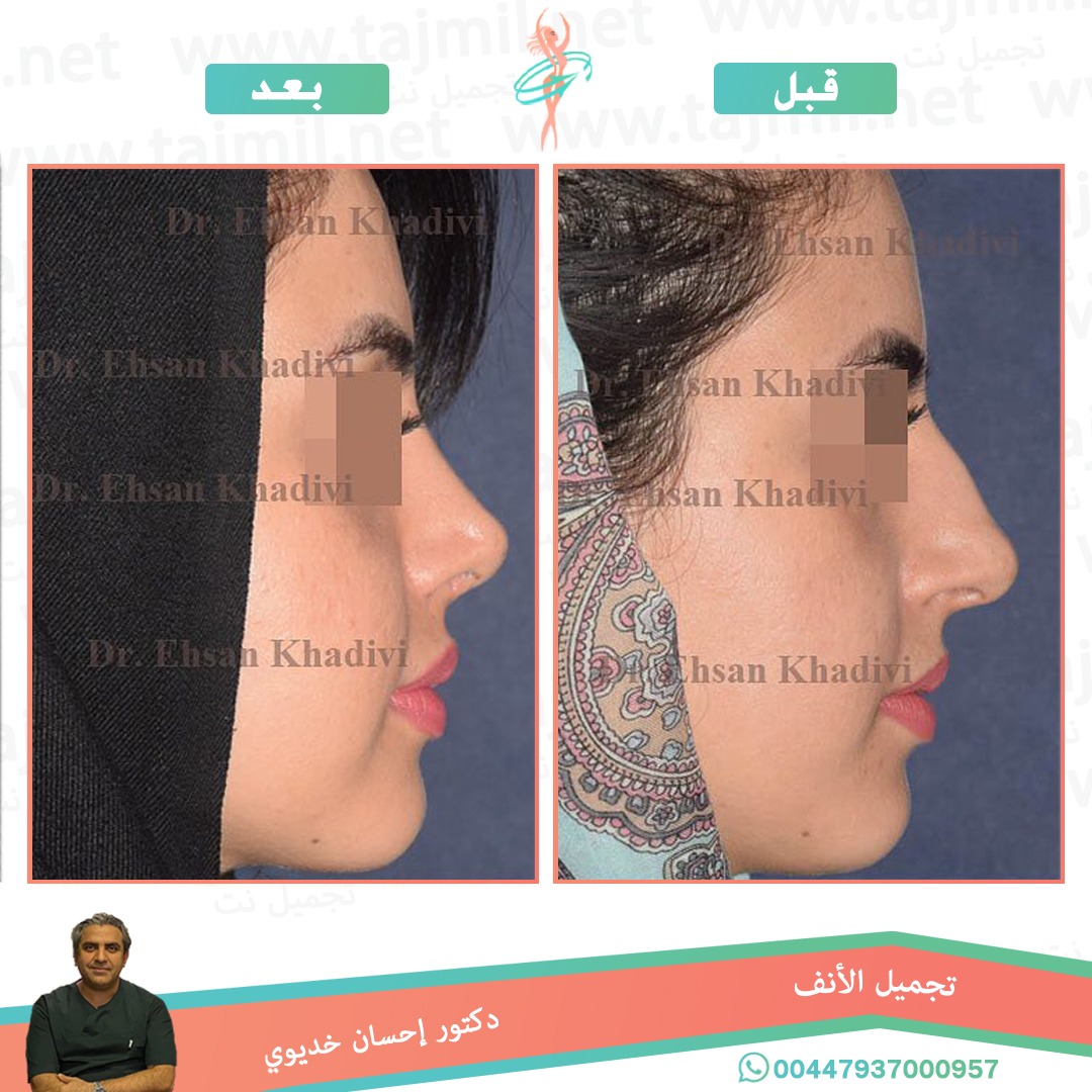  - دکتور إحسان خدیوي عملية تجميل الانف في ايران مع تجميل نت