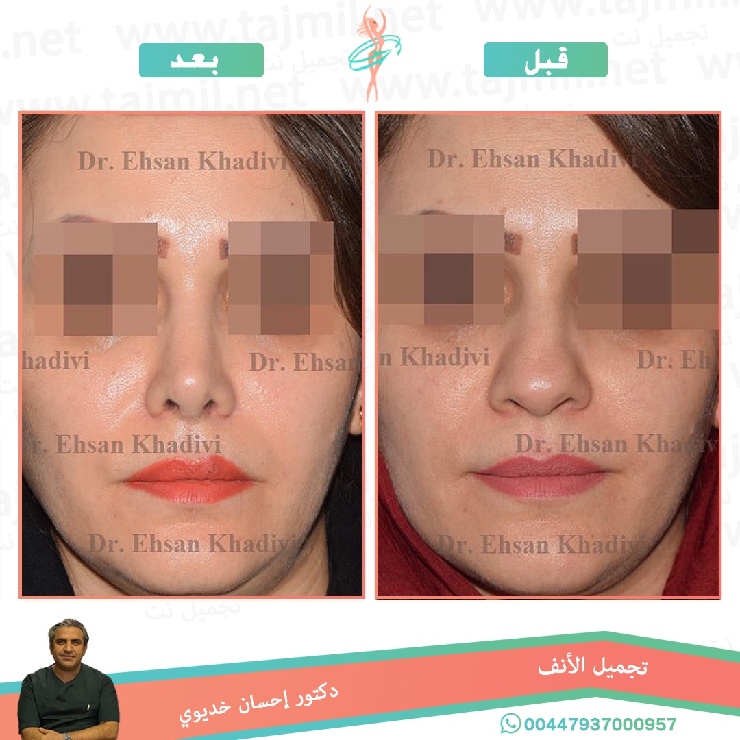  - دکتور إحسان خدیوي عملية تجميل الانف في ايران مع تجميل نت