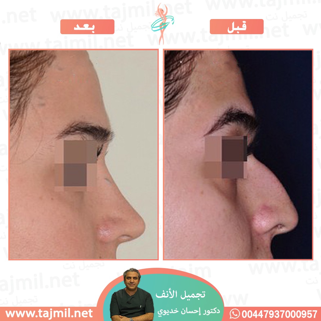  - دکتور إحسان خدیوي عملية تجميل الانف في ايران مع تجميل نت