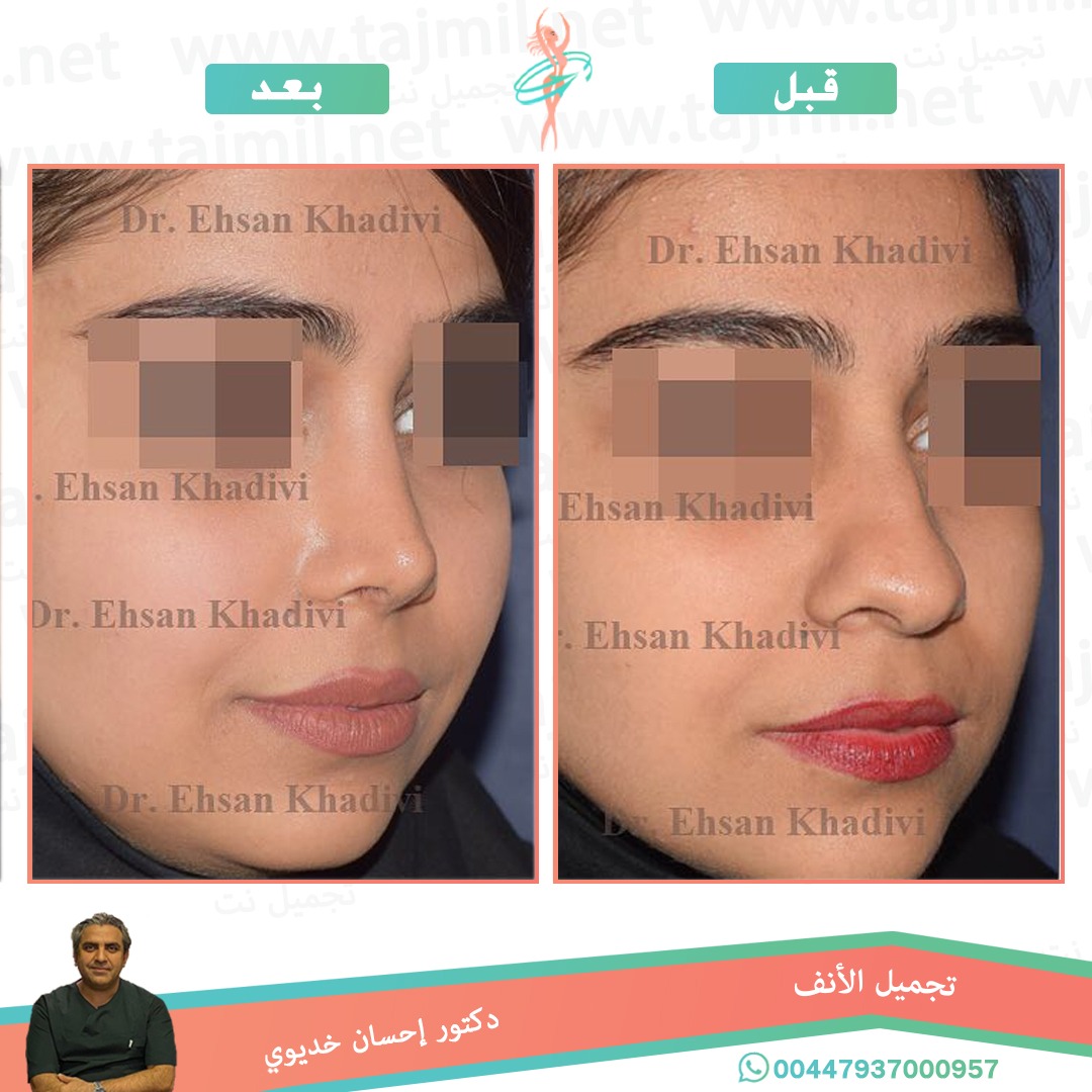  - دکتور إحسان خدیوي عملية تجميل الانف في ايران مع تجميل نت