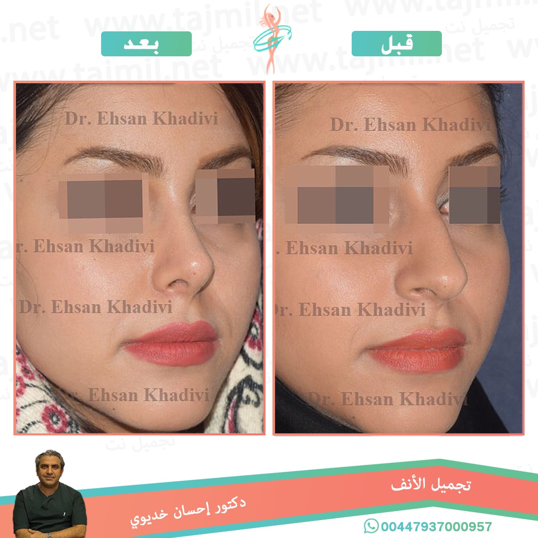  - دکتور إحسان خدیوي عملية تجميل الانف في ايران مع تجميل نت