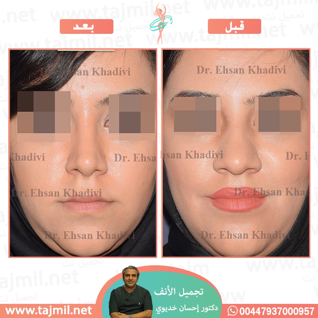  - دکتور إحسان خدیوي عملية تجميل الانف في ايران مع تجميل نت