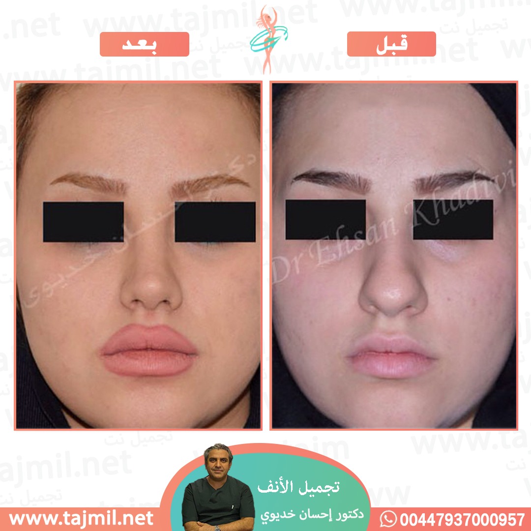  - دکتور إحسان خدیوي عملية تجميل الانف في ايران مع تجميل نت