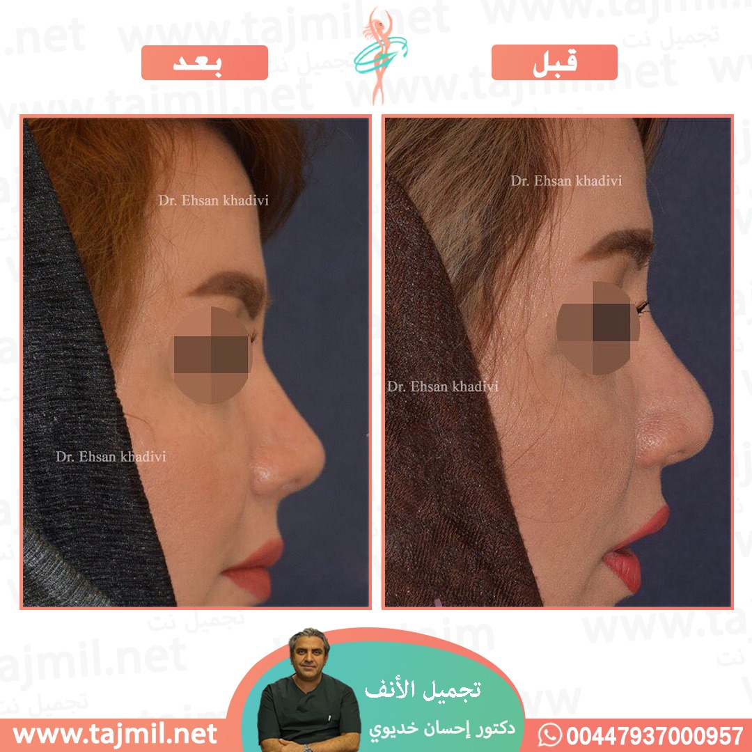  - دکتور إحسان خدیوي عملية تجميل الانف في ايران مع تجميل نت