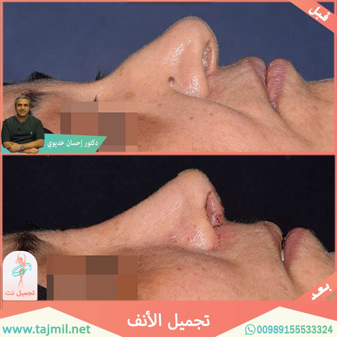  - دکتور إحسان خدیوي عملية تجميل الانف في ايران مع تجميل نت