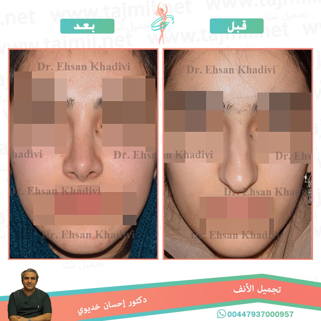  - دکتور إحسان خدیوي عملية تجميل الانف في ايران مع تجميل نت