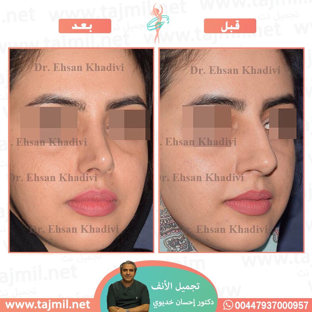  - دکتور إحسان خدیوي عملية تجميل الانف في ايران مع تجميل نت