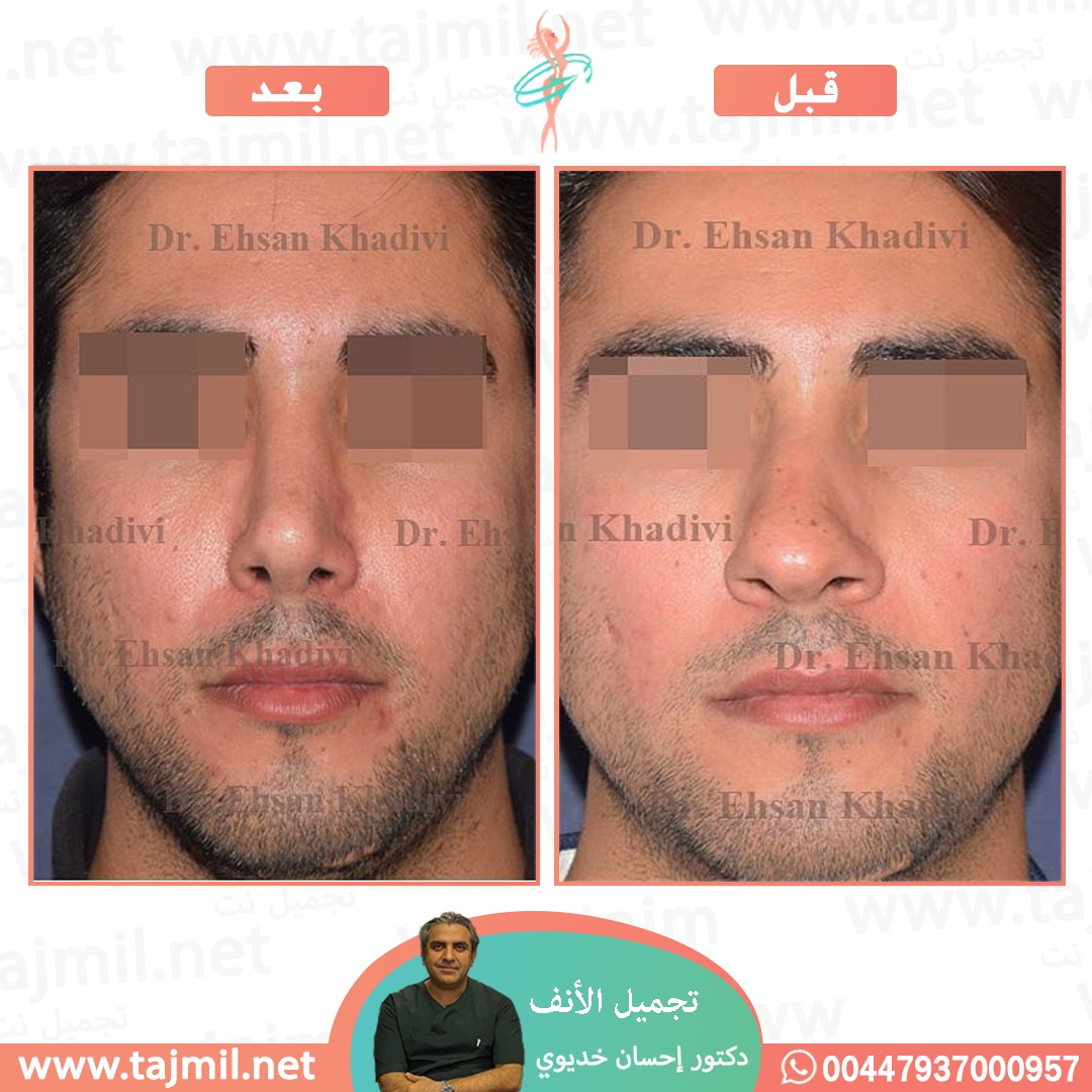  - دکتور إحسان خدیوي عملية تجميل الانف في ايران مع تجميل نت