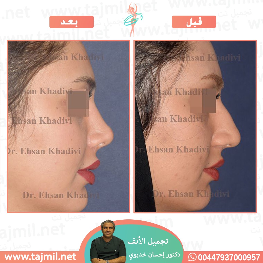  - دکتور إحسان خدیوي عملية تجميل الانف في ايران مع تجميل نت