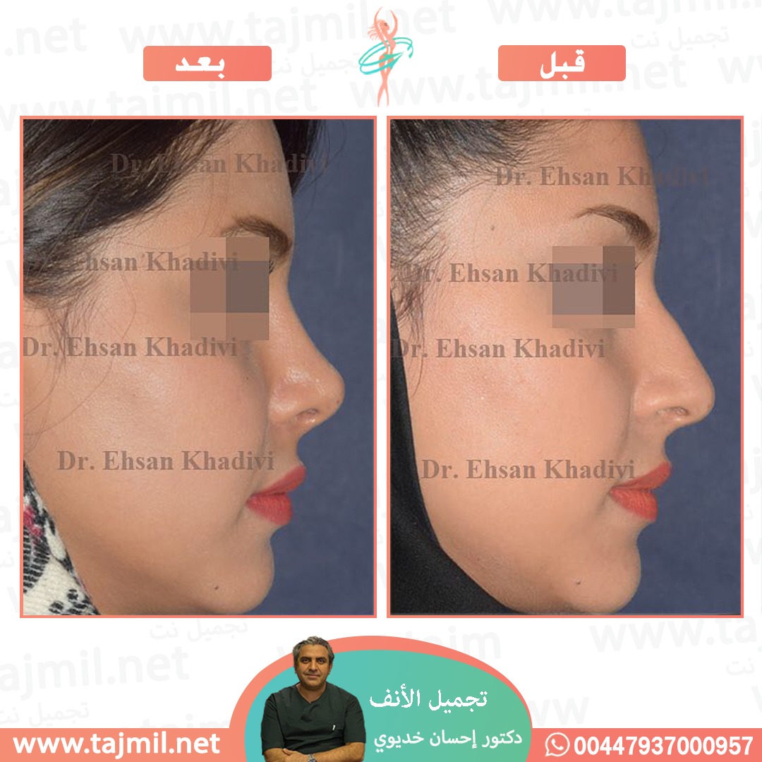  - دکتور إحسان خدیوي عملية تجميل الانف في ايران مع تجميل نت