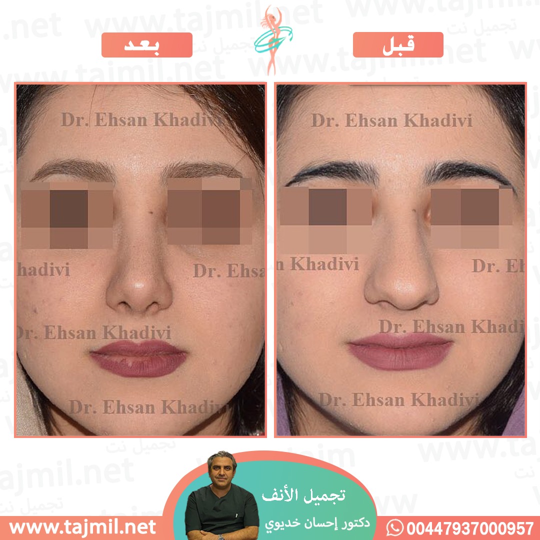  - دکتور إحسان خدیوي عملية تجميل الانف في ايران مع تجميل نت