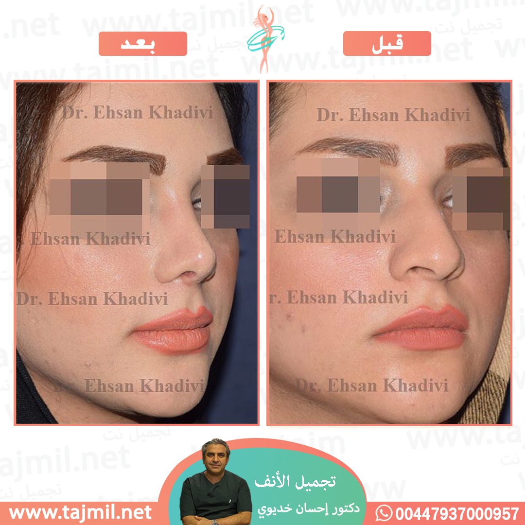  - دکتور إحسان خدیوي عملية تجميل الانف في ايران مع تجميل نت