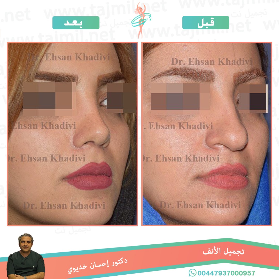  - دکتور إحسان خدیوي عملية تجميل الانف في ايران مع تجميل نت