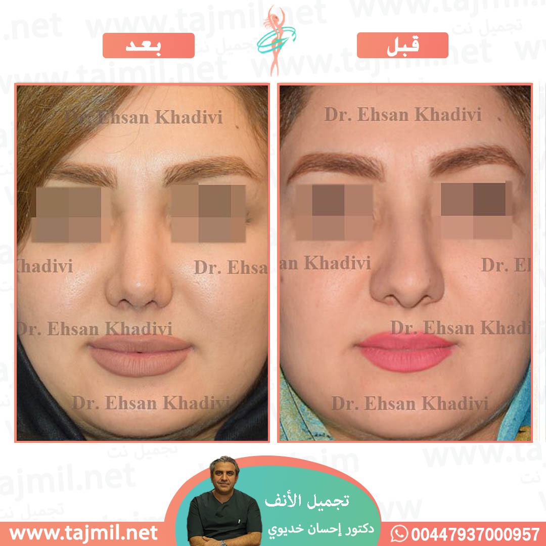  - دکتور إحسان خدیوي عملية تجميل الانف في ايران مع تجميل نت