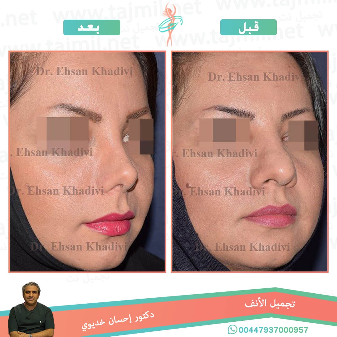  - دکتور إحسان خدیوي عملية تجميل الانف في ايران مع تجميل نت