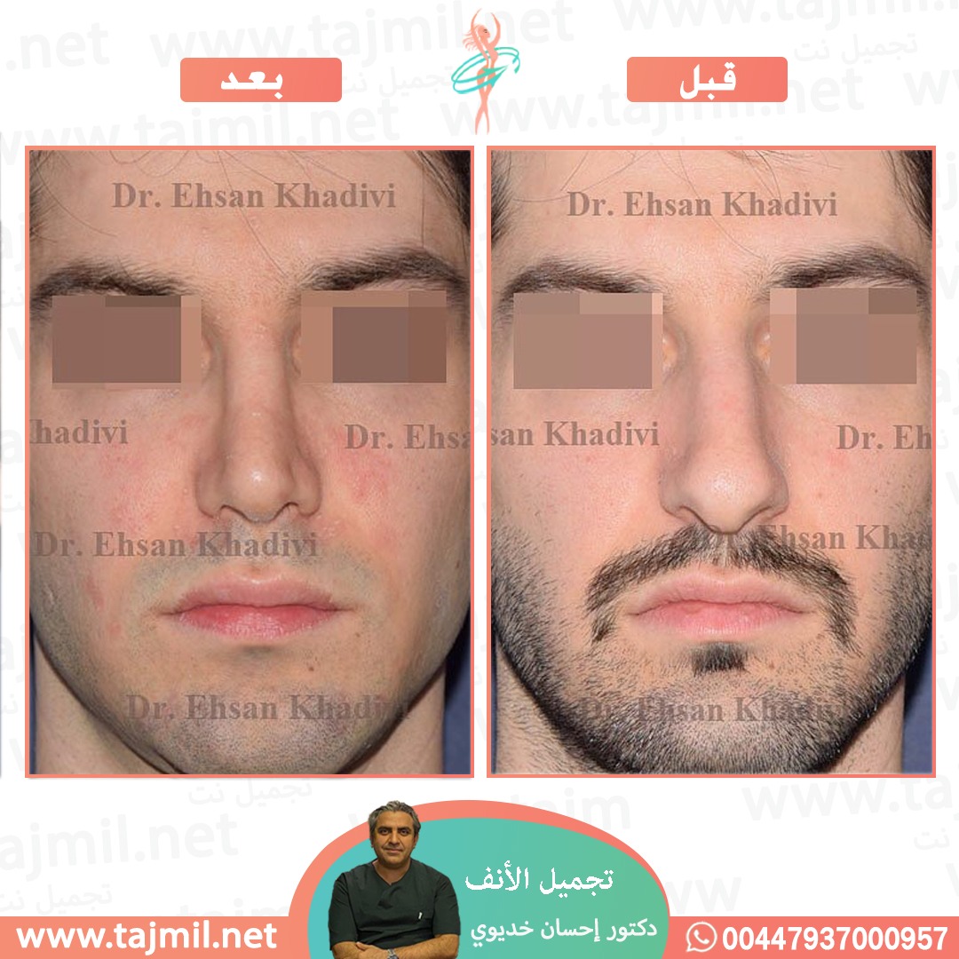  - دکتور إحسان خدیوي عملية تجميل الانف في ايران مع تجميل نت