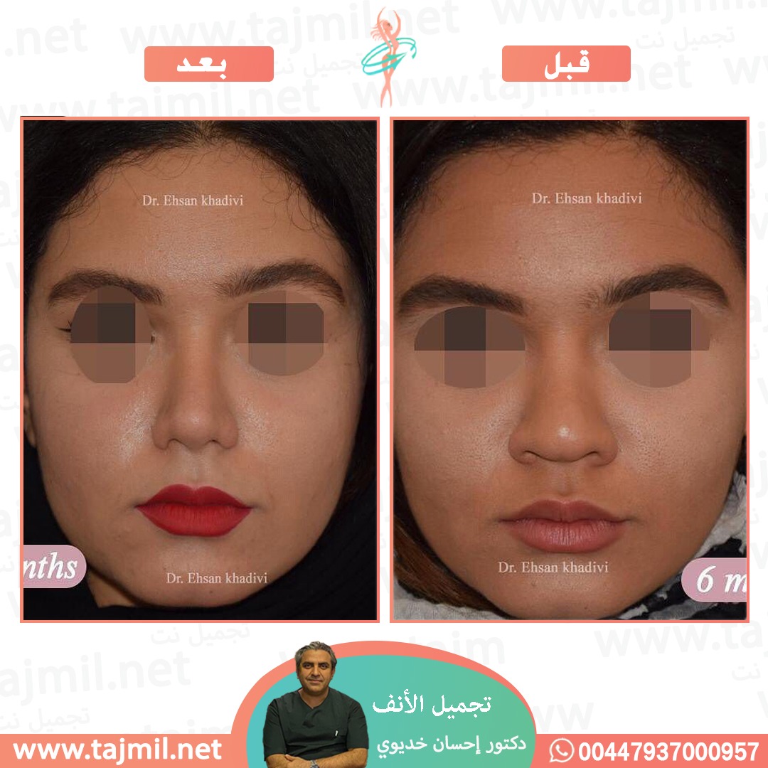  - دکتور إحسان خدیوي عملية تجميل الانف في ايران مع تجميل نت