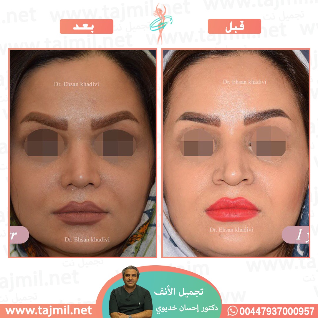  - دکتور إحسان خدیوي عملية تجميل الانف في ايران مع تجميل نت