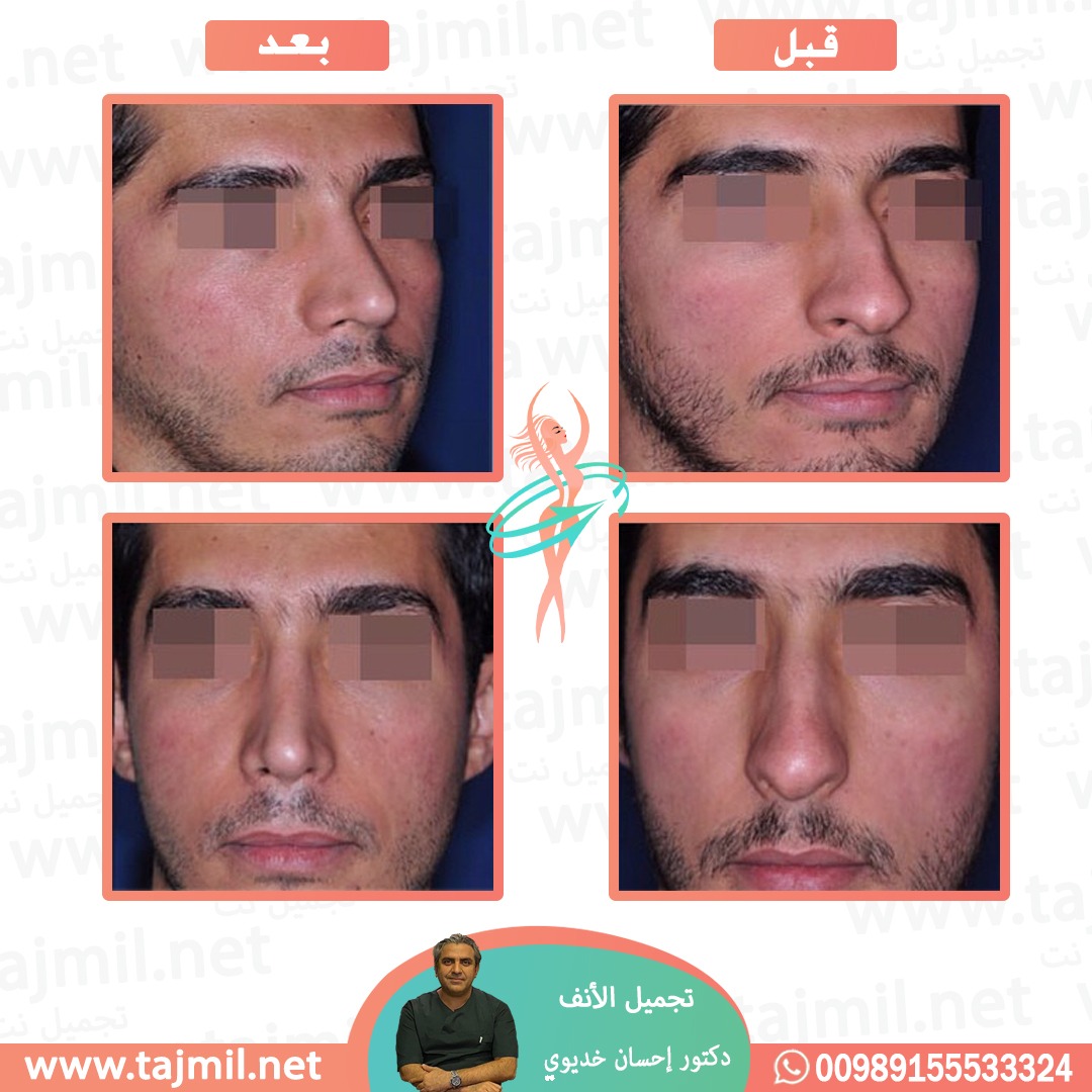  - دکتور إحسان خدیوي عملية تجميل الانف في ايران مع تجميل نت