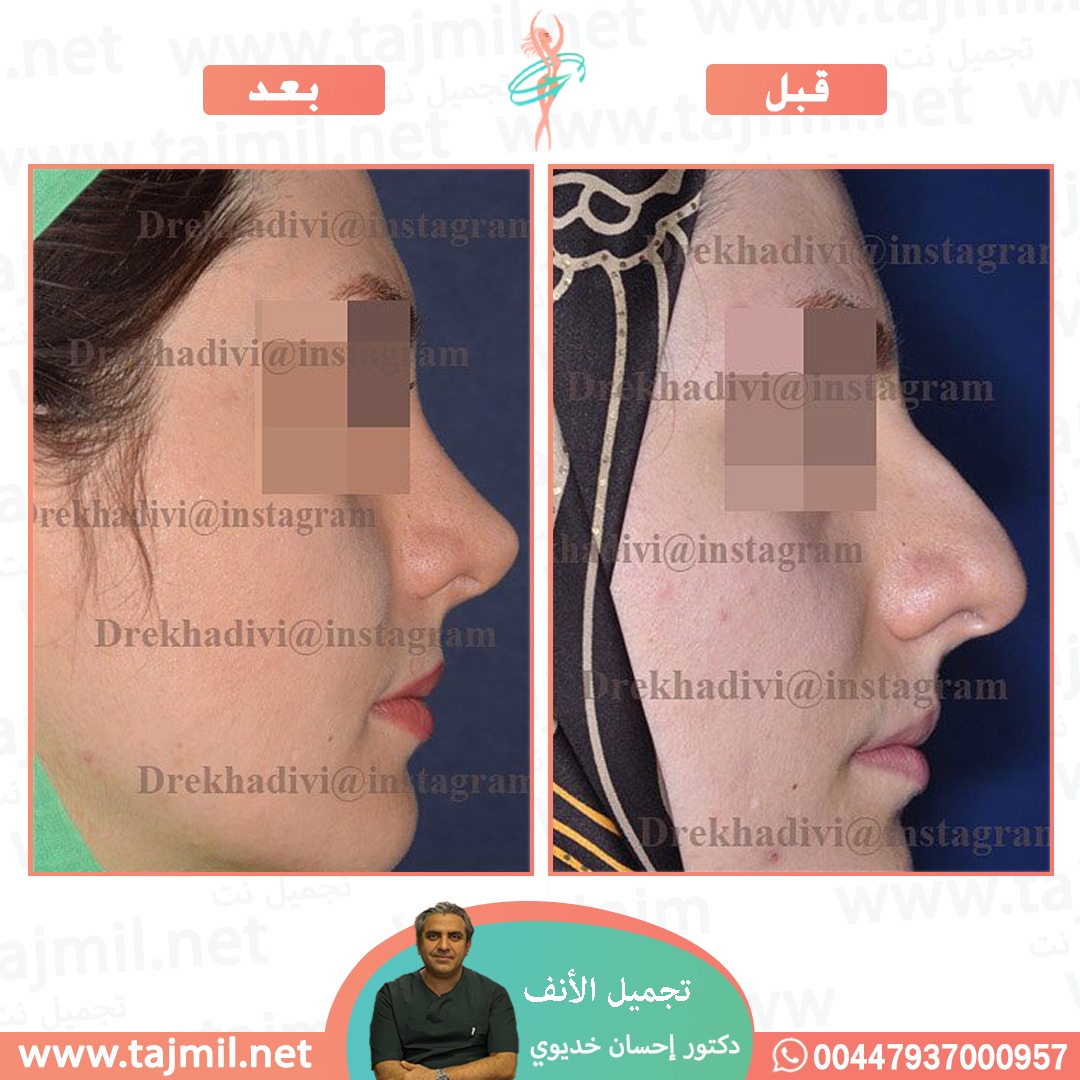  - دکتور إحسان خدیوي عملية تجميل الانف في ايران مع تجميل نت