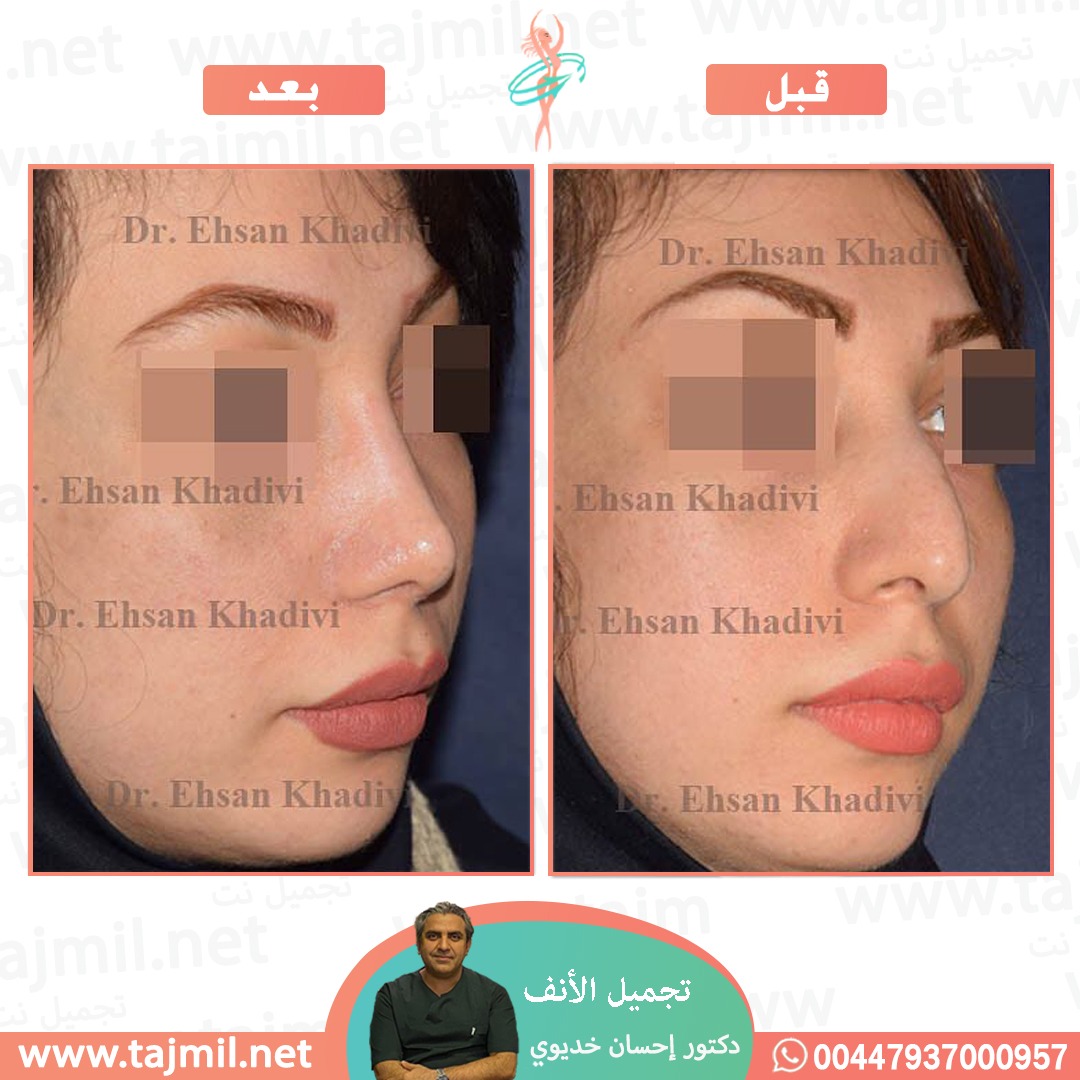  - دکتور إحسان خدیوي عملية تجميل الانف في ايران مع تجميل نت