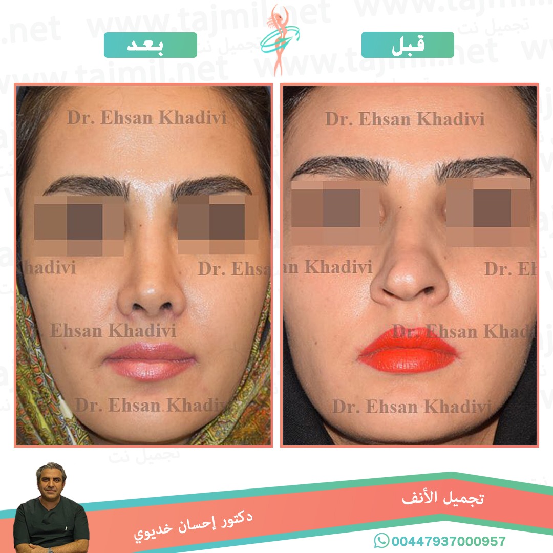  - دکتور إحسان خدیوي عملية تجميل الانف في ايران مع تجميل نت